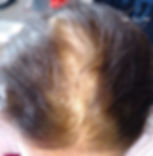 CALVÍCIE GRAU II-2 FRENTE