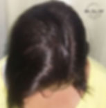 CALVÍCIE GRAU II-1 FRENTE