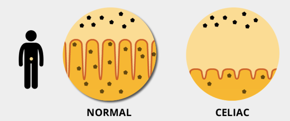 https://www.beyondceliac.org/celiac-disease/facts-and-figures/