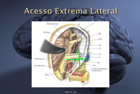MENINGIOMAS DO FORAME MAGNO
