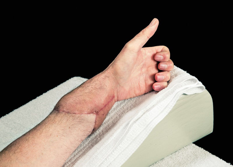 Một bàn tay vừa được ghép vào tay của người bệnh