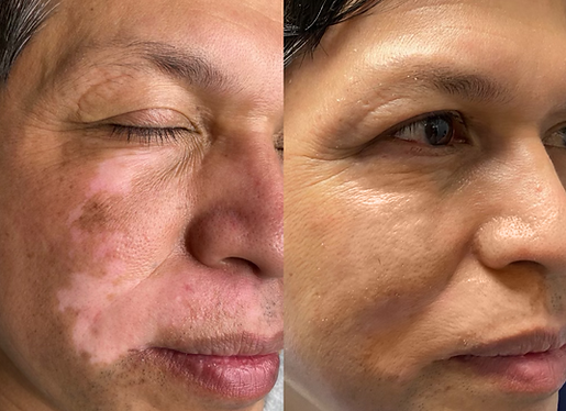 Vitiligo Face revised (1).png