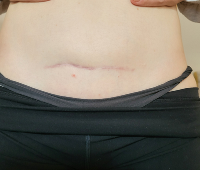 Close up image of post partum C-section scar after treatment.