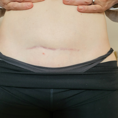 Close up image of post partum C-section scar after treatment.