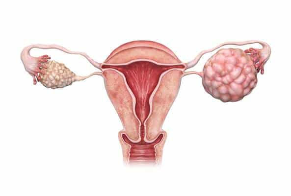 Ovarian tumor treatment in Thane