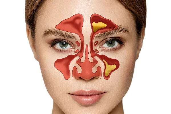 Chronic Sinusitis Treatment in Mumbai – Advanced Sinus Care by Dr. Shama Kovale