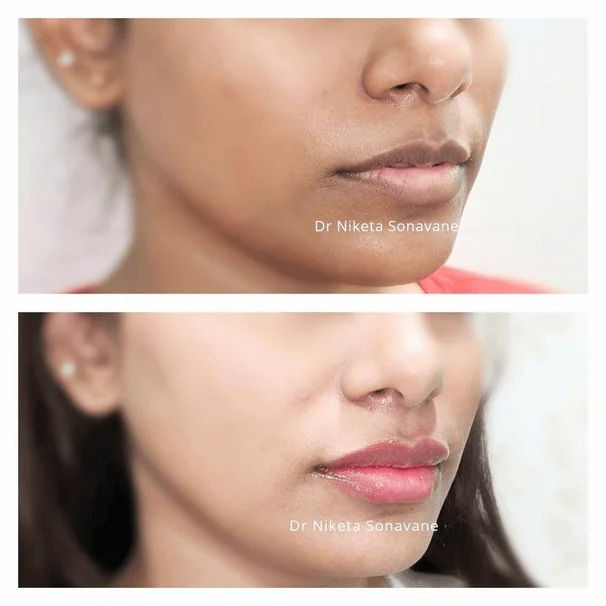 Lip Lightening