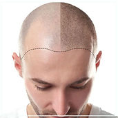Best scalp micropigmentation in Mumbai