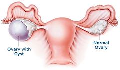 Ovarian cyst surgery in Mumbai