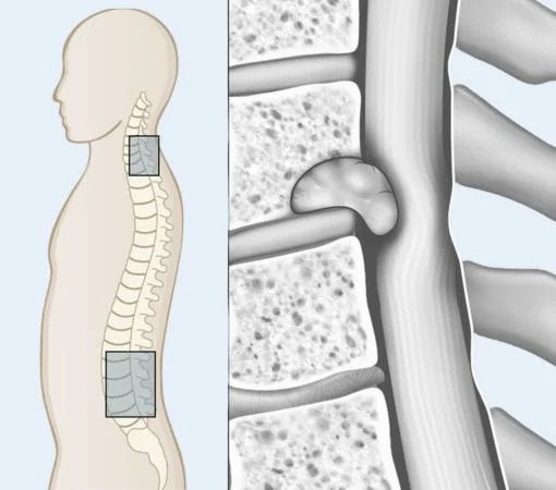 Spinal cord tumor treatment in Mumbai
