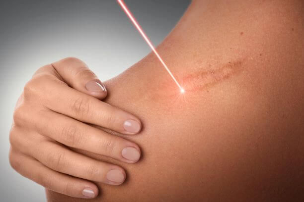 Scar removal surgery in Mumbai