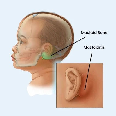 Mastoiditis treatment in Mumbai