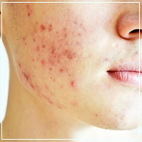 Acne treatment in South Mumbai