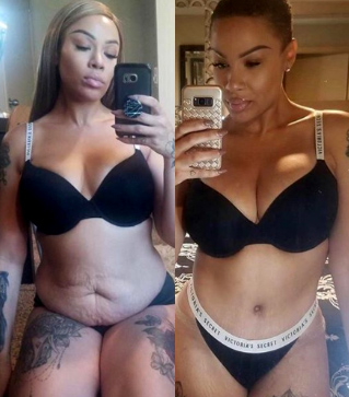 Before & after plastic surgery in Mexico | TopPlasticSurgeonsMexico actual patients