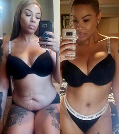 All Inclusive Plastic Surgery Mexico