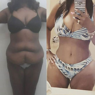 Before & after plastic surgery in Mexico | TopPlasticSurgeonsMexico actual patients