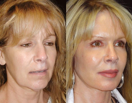 Mexican facelift