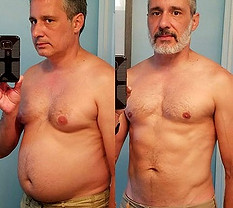 Gynecomastia, Male Breast Reduction Mexi
