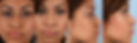 Ethnic Rhinoplasty Mexico