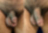 Penoplasty / Penile Lengthening / Girth Enhancement