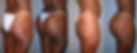 Complete Liposuction + Brazilian Butt Lift / Buttock augmentation through Fat Injection