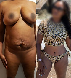 Cheapest Tummy Tuck