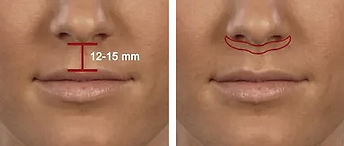UPPER LIP LIFT IN MEXICO