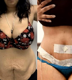 All Inclusive Plastic Surgery Mexico