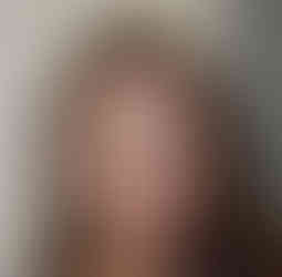 Before Nose Job in Mexico | TopPlasticSurgeonsMexico