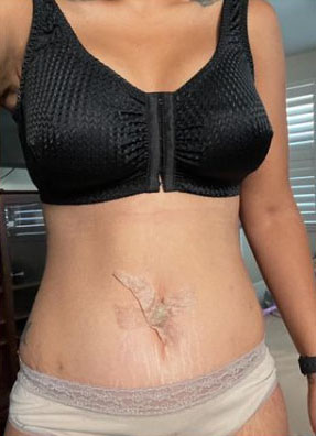 After my plus size Tummy Tuck | TopPlasticSurgeonsMexico