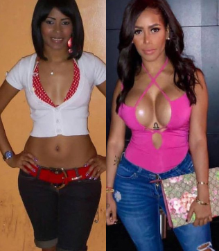 Before & after plastic surgery in Mexico | TopPlasticSurgeonsMexico actual patients