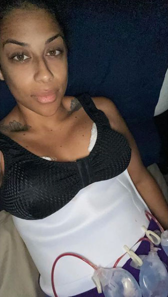 After my Extended Tummy Tuck | TopPlasticSurgeonsMexico