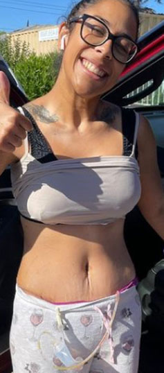 After my extended Tummy Tuck | TopPlasticSurgeonsMexico