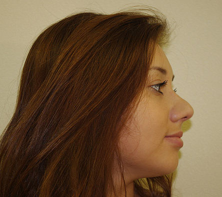 Before Rhinoplasty in Mexico | TopPlasticSurgeonsMexico