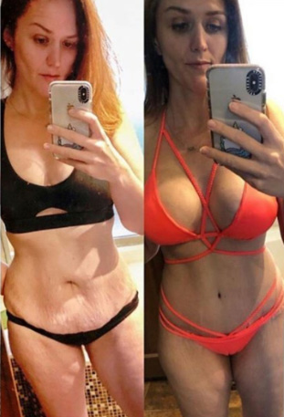Before & after plastic surgery in Mexico | TopPlasticSurgeonsMexico actual patients