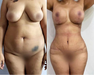 Before & after plastic surgery in Mexico | TopPlasticSurgeonsMexico actual patients