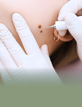 WARTS REMOVAL - SEVERE PER AREA (FACE_NECK_ CHEST_TUMMY _BACK).png