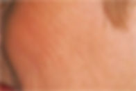 Face Skin Tightening before at TEAL