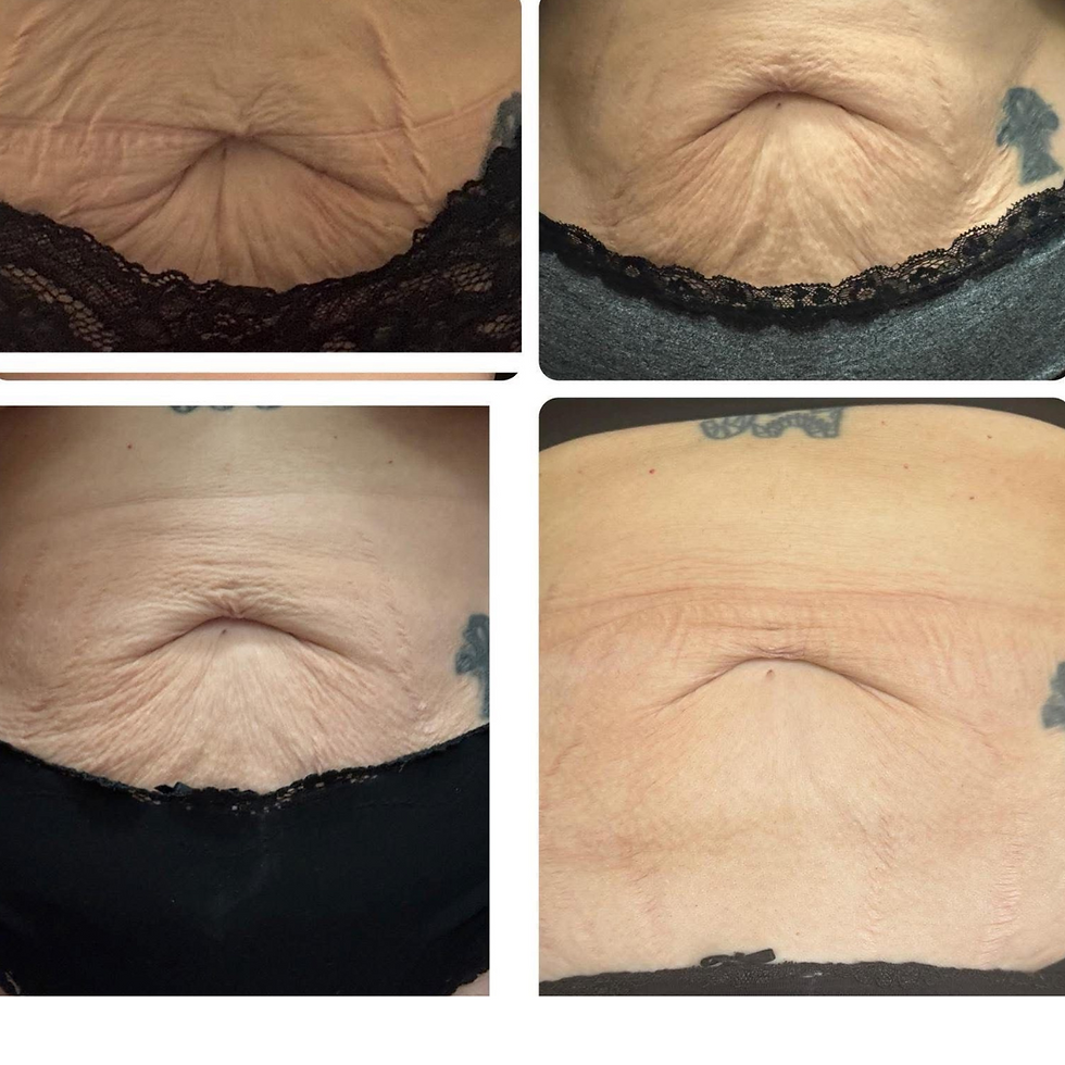 Close-up of a person's abdomen with loose skin in different angles, set against a dark background, showing black lace clothing detail. a before and after showing much tighter skin the the after photo