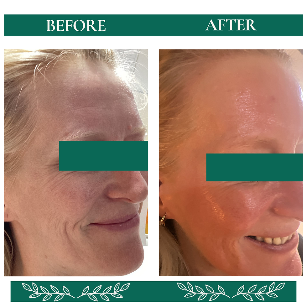 Before-and-after images of a person's face showing skin improvement. Left side has wrinkles, right side is smoother and glowing. After having a chemical peel treatment.