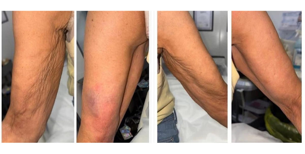 Four images of an arm before and after a procedure. Visible wrinkles reduce over time. Background includes a bed and medical setting.