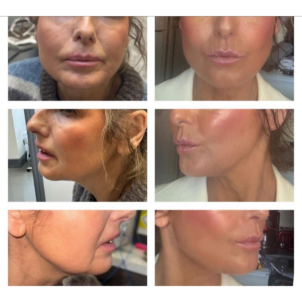 Six-panel collage showing side and front views of a woman's face before and after Endolift treatment. The focus is on glowing skin and enhanced features.