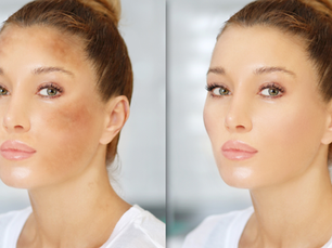 Medical Aesthetics Toronto: Best Hyperpigmentation Treatments for Clear Skin