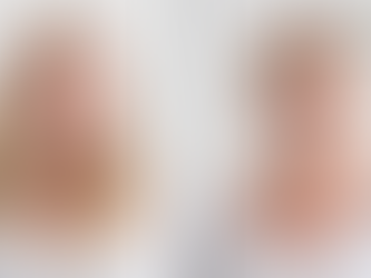 How PDRN Salmon Sperm Microneedling in Toronto Can Transform Your Skin Naturally