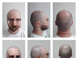 Micro scalp pigmentation