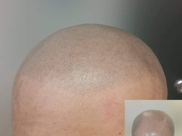 Micro scalp pigmentation