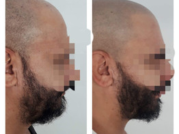 Micro scalp pigmentation