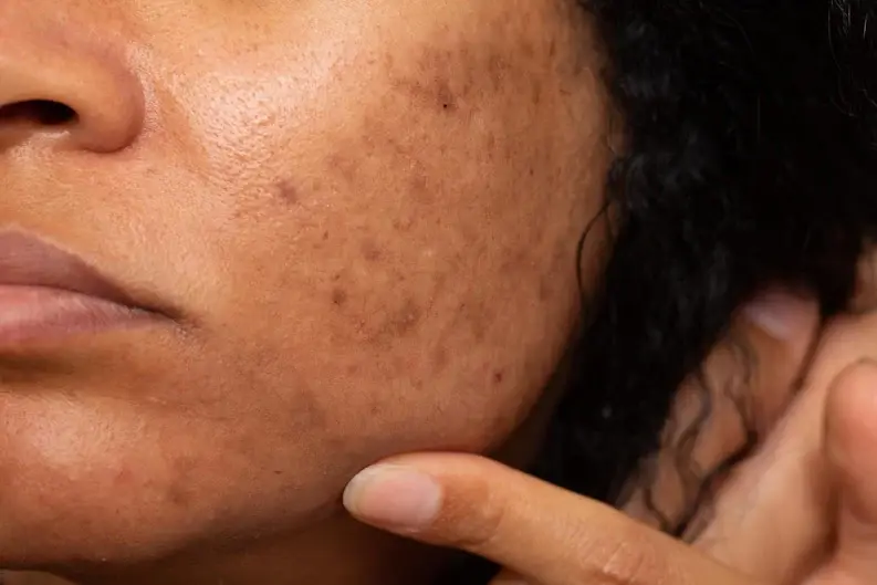 Main_image_dull_skin.webp