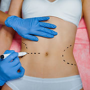 Abdominoplasty