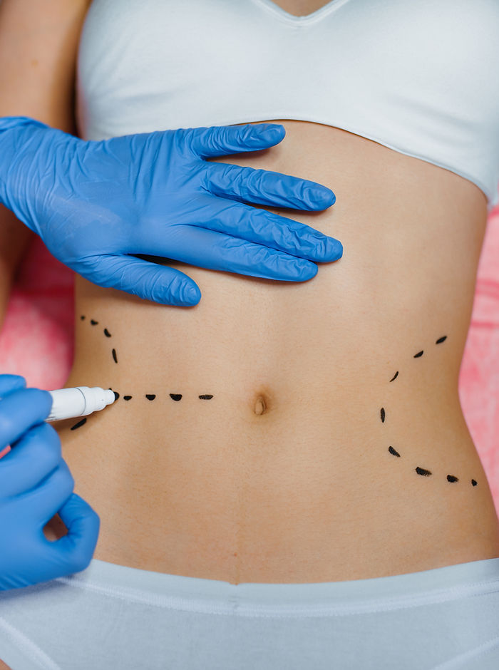 Abdominoplasty